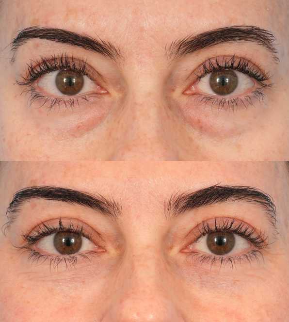 Rizinusöl-Augenserum – Pflege gegen Augenringe und Schwellungen 